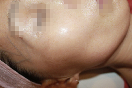 기미+흑자 치료 후