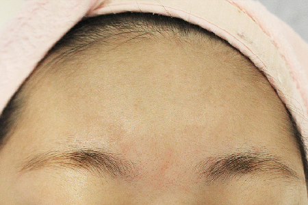 알라딘필링 후