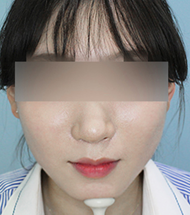 턱보톡스 3주 후
