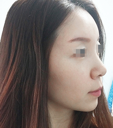 풀페이스필러 2주 후