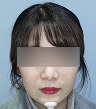 팔자필러 2주 후