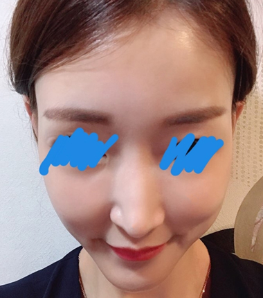 볼필러 2주 후