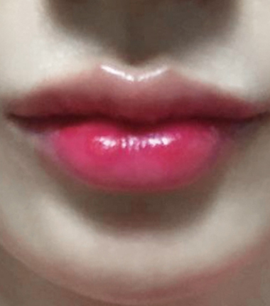 입술필러 1주 후