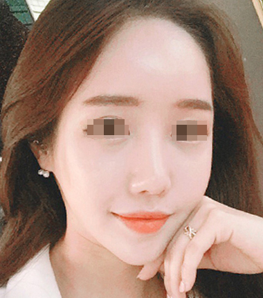 큐오필 12cc 2주 후