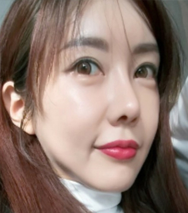 큐오필 12cc 2주 후