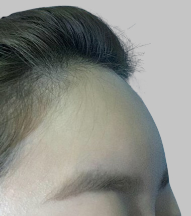 이마필러 2주 후