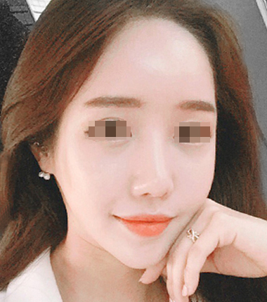 큐오필 12cc 2주 후