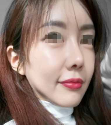 큐오필 12cc 2주 후