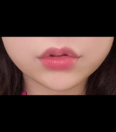 무턱필러 시술 후