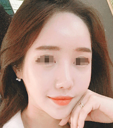 큐오필 12cc 2주 후