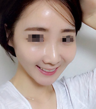 큐오필 6cc 2주 후