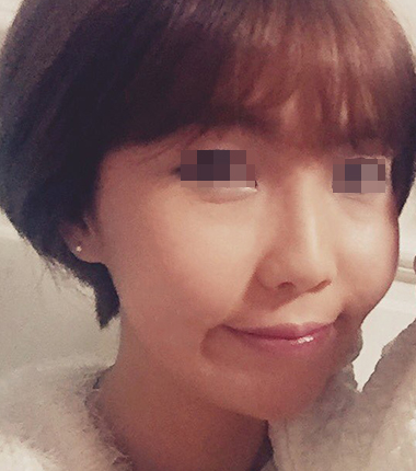 큐오필 6cc 2주 후