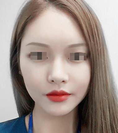 큐오필 6cc 2주 후