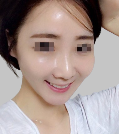 큐오필 6cc 2주 후