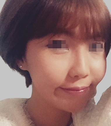 큐오필 6cc 2주 후