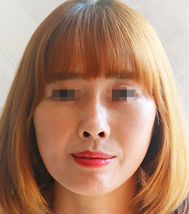 실리프팅 한달 후