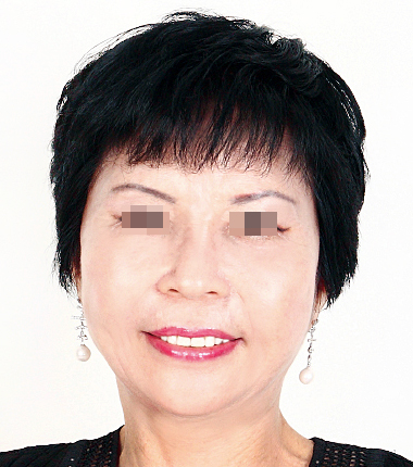 풀페이스리프팅 한달 후