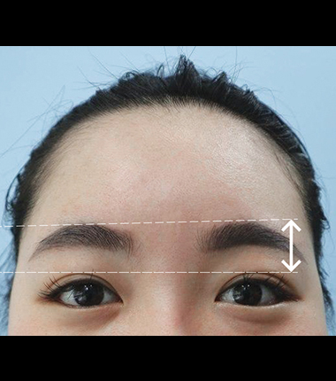눈썹 이마거상술 한달 후