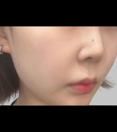 온다 리프팅 시술 후