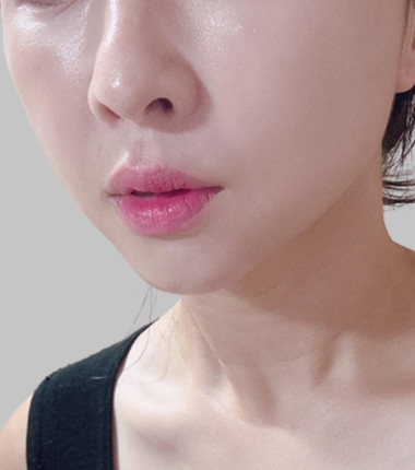 온다 리프팅 시술 후