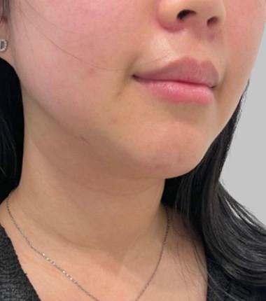 온다 리프팅 시술 후