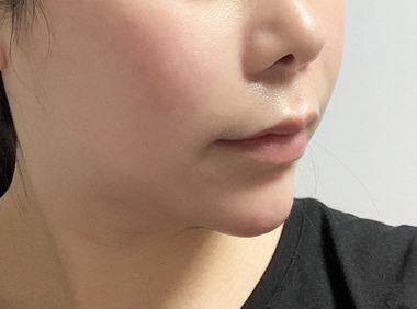 이중턱흡입+근육묶기 3개월 후