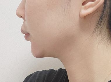 이중턱흡입+근육묶기 한달 후