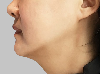 이중턱흡입+실리프팅 2주일 후