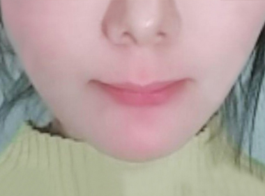 이중턱흡입+실리프팅 3개월 후