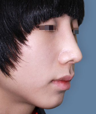 코성형수술후