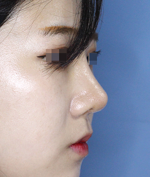 코성형수술후