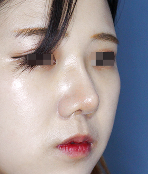 코성형수술후
