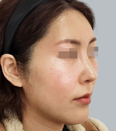 개방코성형 한달 후