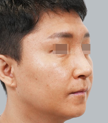 개방코성형 2주 후