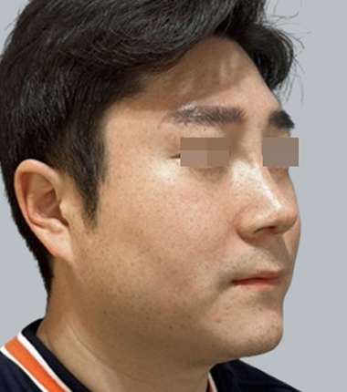 개방코성형+자가늑연골 한달 후