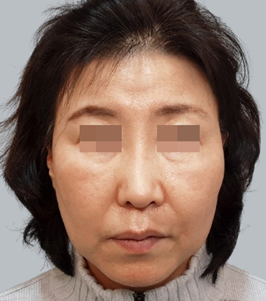 개방코성형+자가늑연골 한달 후