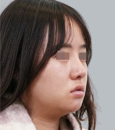 개방코성형+자가늑연골 2주 후