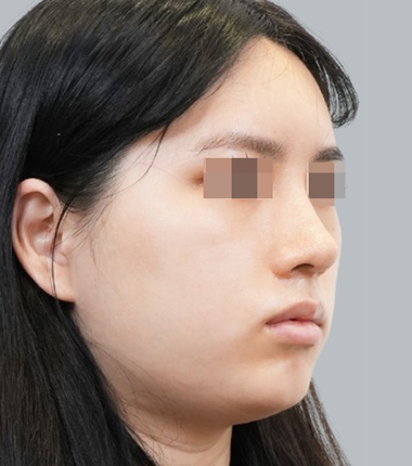 개방코성형(매부리) 재수술