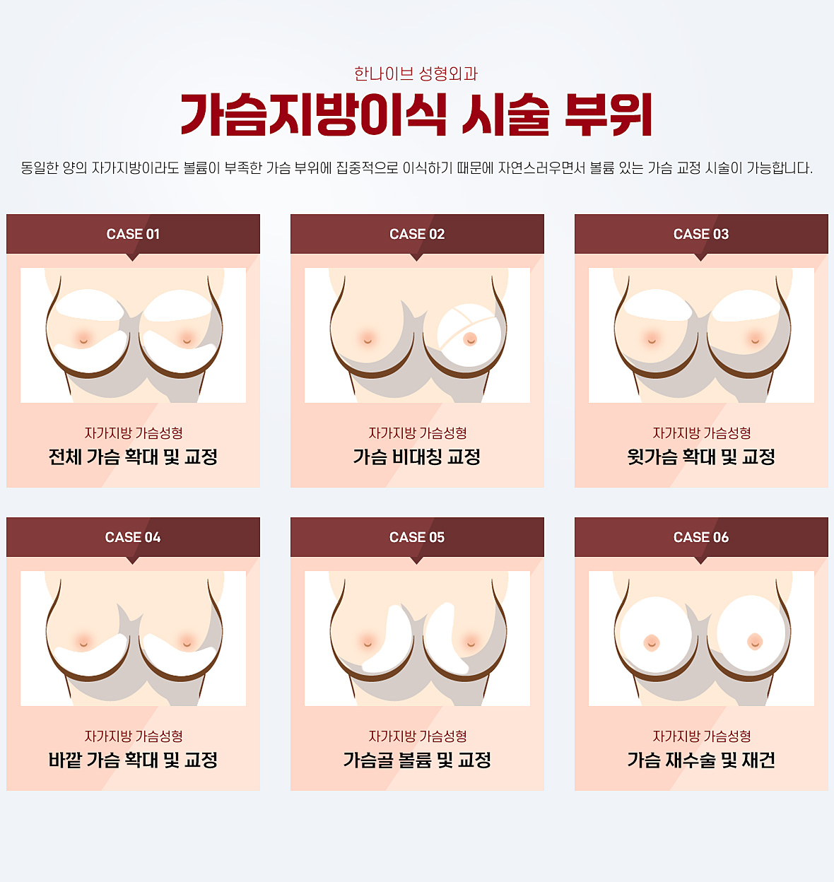 가슴지방이식시술부위