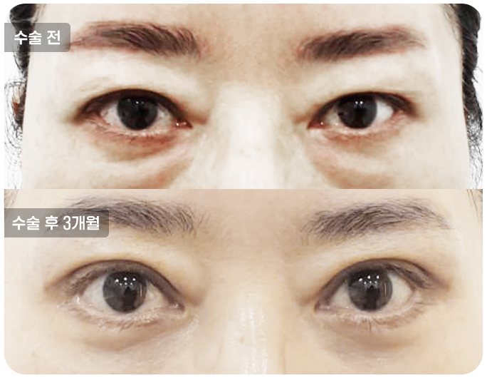 상안검수술전후사진