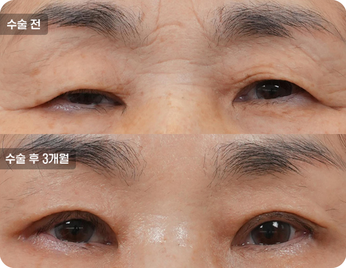 상안검수술전후사진