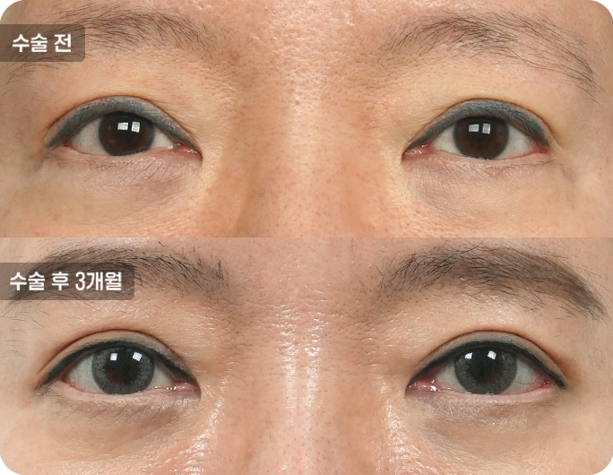 상안검수술전후사진