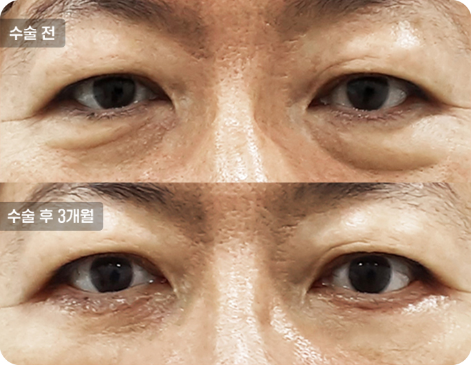 하안검수술전후사진