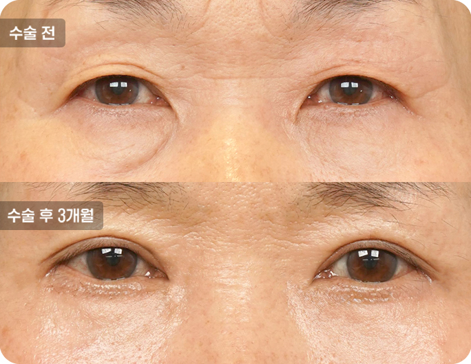 하안검수술전후사진