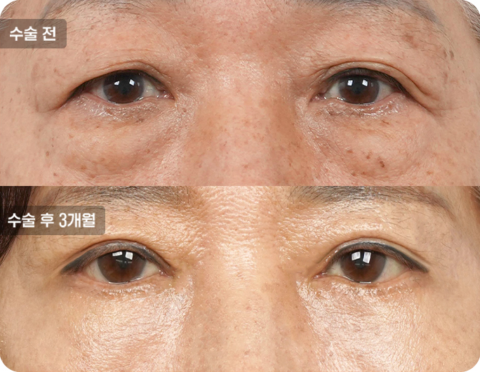 하안검수술전후사진