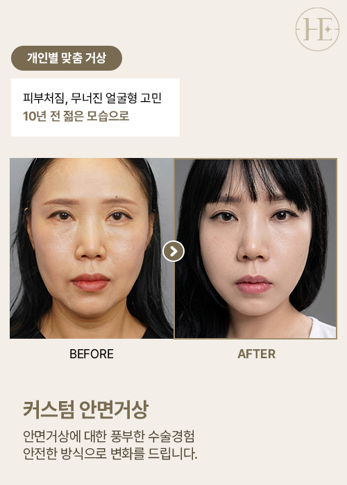 커스텀안면거상