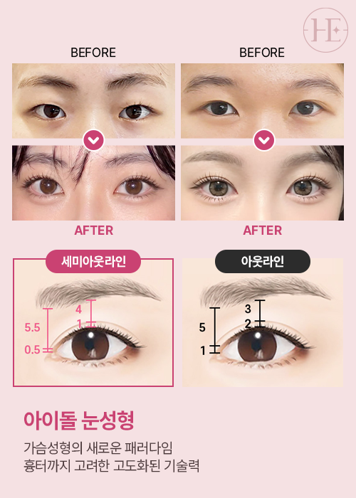 아이돌눈성형