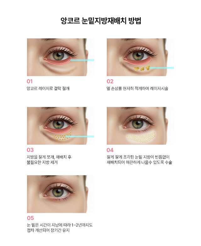 앙코르 눈밑지방재배치 방법