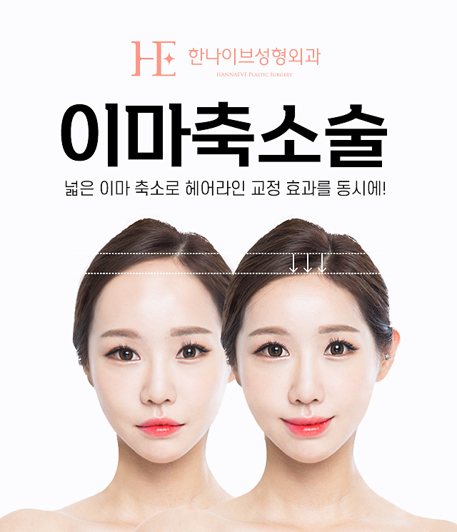 한나이브이마축소술