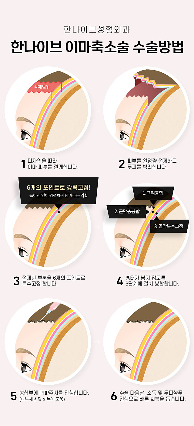 한나이브이마축소술수술방법